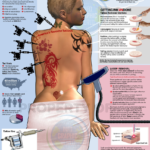 Guide to Tattoo Removal